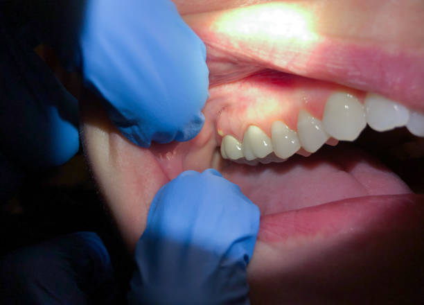 Best Emergency Wisdom Teeth Removal in Porcupine, SD