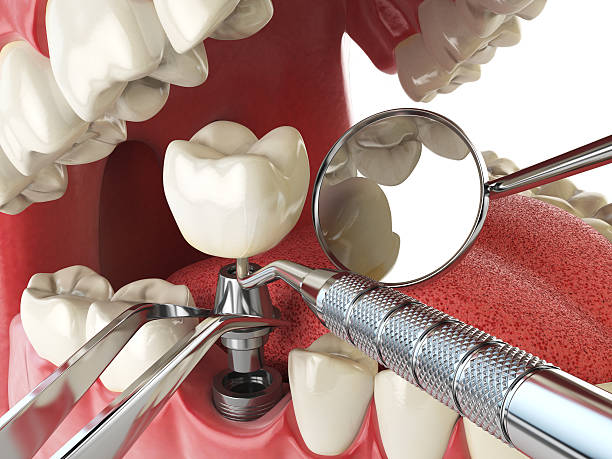 Best Emergency Dental Care for Broken or Chipped Teeth in Porcupine, SD